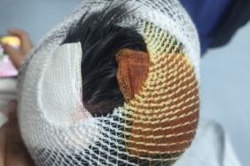 KÖPEK SALDIRISINA UĞRAYAN ÇOCUĞUN BAŞINA 15 DİKİŞ ATILDI
